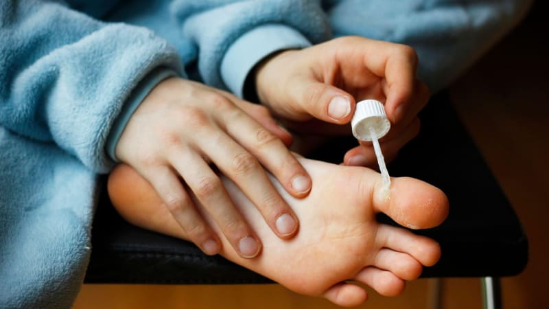 Bradavice jako suvenýr z tábora. Virus má až třetina dětí, jak se ho zbavit před startem školy?